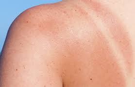 Weiter unten erkläre ich dir, wie. Sonne Und Ihre Wirkung Bei Akne Und Unreinheiten Eau Thermale Avene
