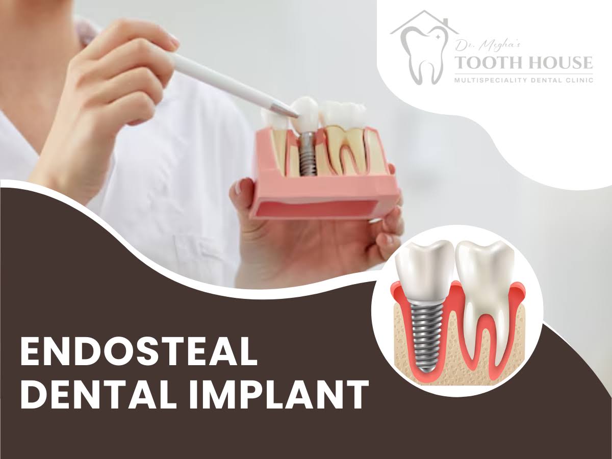 Endosteal Dental Implants product image