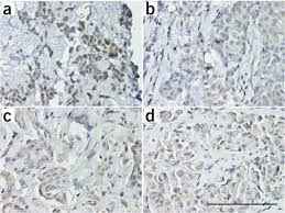 Less than half of mesothelioma patients today undergo genetic testing. Germline Bap1 Mutations Predispose To Malignant Mesothelioma Nature Genetics