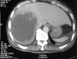 Image result for Liver Abscess