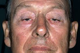 Myasthenia Gravis Symptoms Nhs