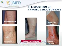 Lipodermatosclerosis Google Search