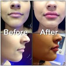Lip Augmentation Done By Amazing Cosmetic Dermatology Specialist And Consultant Roya At Davisville Location Hea Lip Augmentation Dermal Fillers Lip Injections