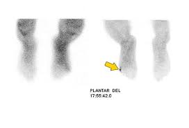 Image result for Osteomyelitis Bone Scan