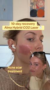 Alma Hybrid Laser Before After