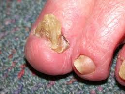 انعقاف الأظافر Horn nails ) )(Onychogryphosis - الدكتور مازن كردية