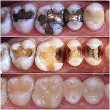 Replacing Old Amalgam Fillings With White Composite Fillings Dental Fillings Dental Hygiene School Dental Emergency