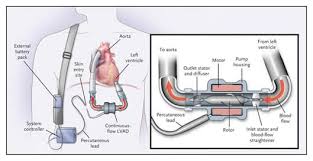 You're not currently eligible for a heart transplant because of age or other conditions. Left Ventricular Assist Device Lvad Stanford Health Care