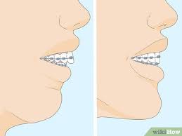 You'll need to wear braces for about 2 years. 7 Ways To Fix An Overbite Wikihow