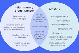 Image result for Inflammatory breast cancer