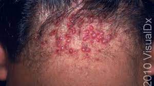 Why do you get muscle knots? Nasty Bumps On The Back Of Your Head What Are They And How To Get Rid Of Them Hubpages