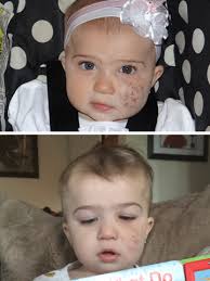 New Laser Treats Children with Vascular Anomalies