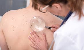Of course, your specialist is the main person whose advice you should follow but it doesn't do anyone harm. Skin Cancer Treatments Houma La Non Melanoma Cancer Skin Care