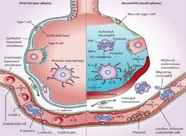 Image result for Transfusion Associated Circulatory Overload