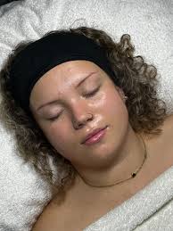 MODEL CALL* 📍B67 6H7 I am a former GDC nurse who now specialises in skin.  I am looking for models who are happy to have a microneedling session or a  chemical peel