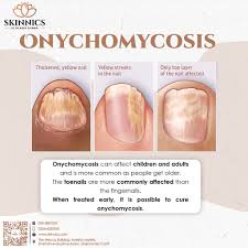 Image result for onychomycosis
