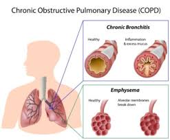 Image result for COPD Management