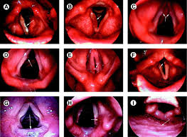 Image result for Reflux Laryngitis