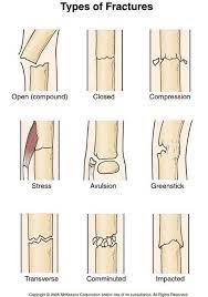 Fractures Medical Terminology Medical Knowledge Medical Education