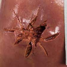 This article on gunshot wounds deals with the medicolegal aspects of fatalities from firearm injuries, with special emphasis on the morphological findings and their correct interpretation. Gunshot Wound To Liver Radiology Case Radiopaedia Org