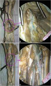 Der wächterlymphknoten ist der erste lymphknoten, der das blut aus tumorbefallenen organen empfängt. Deep Lymphatic Anatomy Of The Upper Limb An Anatomical Study And Clinical Implications Sciencedirect
