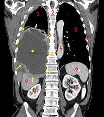 This system uses gray transformation for image contrast enhancement. Cancer Wikipedia