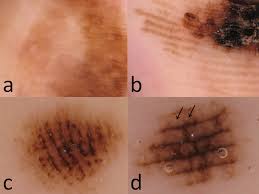 From creams to surgery, there are several possible treatment options to undertake, depending on the stage. Management Of Acral Lentiginous Melanoma Intechopen