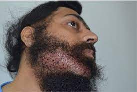 If you are looking for the best facilities, international level services, best outcomes at an affordable cost then medispa hair transplant clinic is apparently among the best options for hair transplant in india. Beard Transplant In India Facial Hair Transplant And Cost