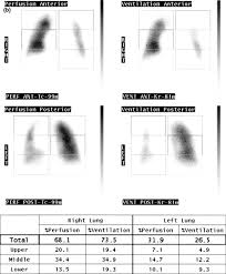 Image result for Ventilation Perfusion Scan