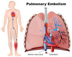 1 ¿qué es una trombosis? Embolia Pulmonar