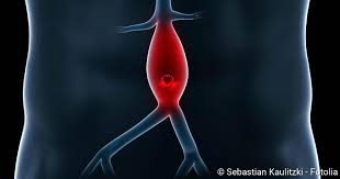 Aneurysma Formen Warnzeichen Ursachen Erste Hilfe Netdoktor