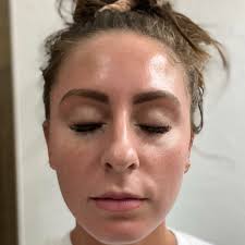 LOVE this before and after! She wanted to wear makeup for events and work  but had inflamed acne and hyperpigmentation. She struggled for years until  we started the acne series! Look at