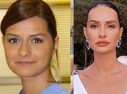 doktorlar ela estetikli unlulerden olup botox rhino ve lip islemlerine tabi olmus kadinca fikir kadinca fikir unluler kadin fotograf