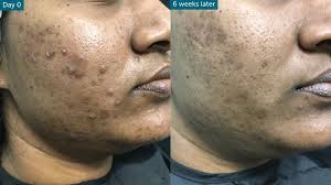 Image result for acne face
