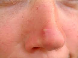 Image result for skin cancer on nose pimple