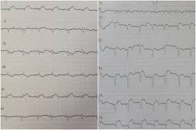 Krevní tlak se vyjadřuje ve dvou hodnotách. Plicni Embolie Ekg Shefalitayal