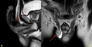 Image result for Undescended Testicle