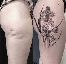Dermaflage is applied as a gel and it conforms to your skin with the help of a texturizing. Scarring Form David Allen