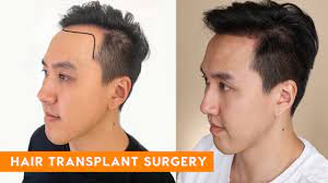 Performed since the 1950s in the united states, hair transplants have significantly improved in terms of safety and effectiveness over the years. Hair Transplant Surgery Best In Beauty Youtube