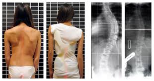 Neuromuscular scoliosis encompasses scoliosis that is secondary to neurological or muscular diseases. Scoliosis Wikipedia