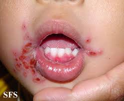 Herpes simplex virus two further conditions, seen especially in children, are herpetic gingivostomatitis and herpetic whitlow. Herpetic Gingivostomatitis Wikidoc