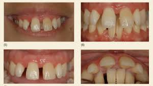 Image result for Dentition
