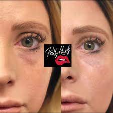 Tear Trough Filler Done By Missy Bowie At Pretty Hurts In Dallas Texas Pretty Hurts Cosmetic Injectables Botox