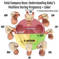 Image result for Manual Rotation in Occipitoposterior Presentation