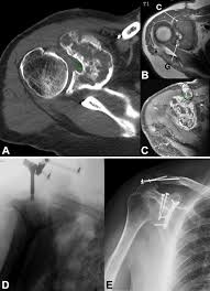 Image result for Shoulder History