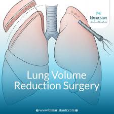 Image result for Lung Volume