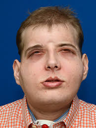 Volunteer firefighter receives 'extensive' face transplant