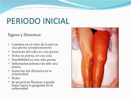 Es un riesgo muy elevado que debemos conocer para evitar complicaciones en la salud. Tipo De Dolor Trombosis Venosa Profunda Como Detectar Y Advertir Solfa Syllable Trombosis Venosa Profunda