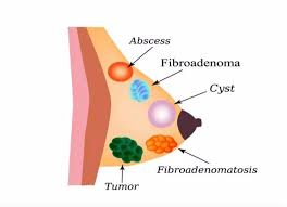 Medical diagram of breast cross-section showing cyst, tumor, fibroadenoma, abscess, and related conditions