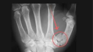 Bennet's Fracture